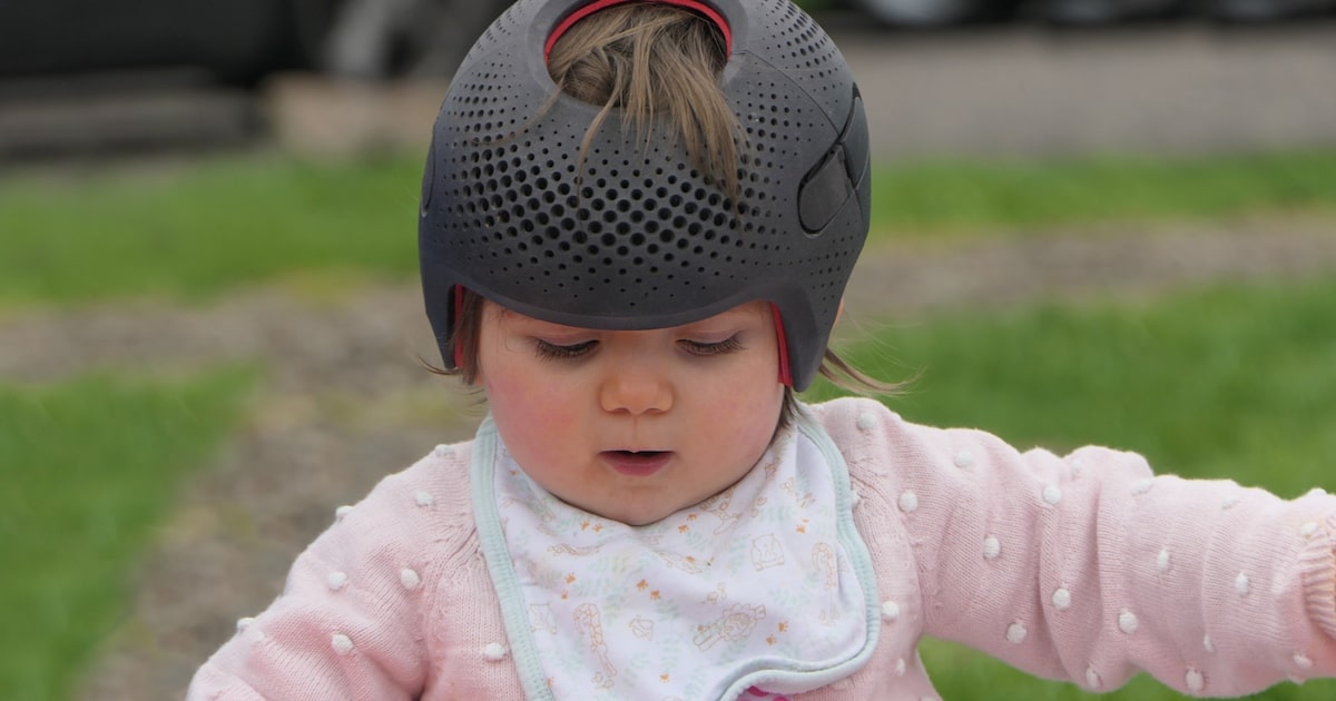 Assimetria craniana: uso de capacete em bebê nem sempre tem indicação